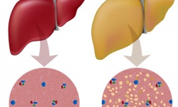 ‘Điểm mặt’ những nguyên nhân gây bệnh gan nhiễm mỡ